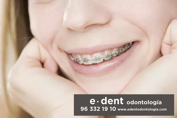 Ortodoncias infantil y para adultos en Valencia